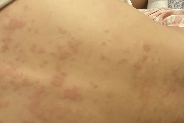 皮肤过敏的图片