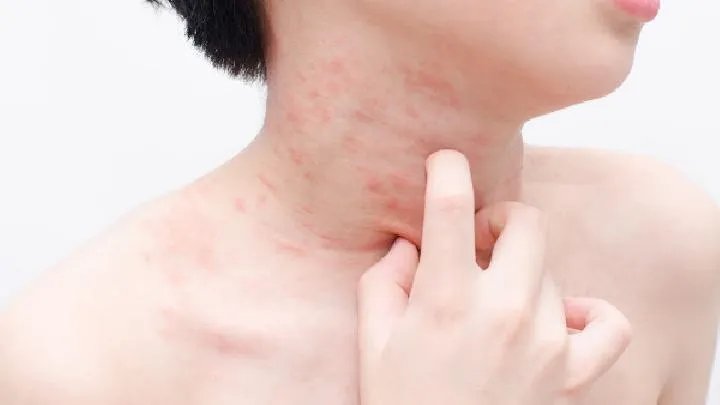 湿疹的症状