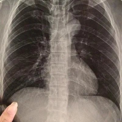艾康宝治疗小细胞肺癌吗?