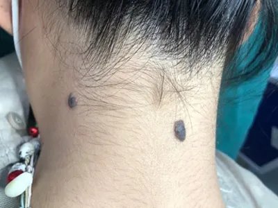 皮内痣黑痣图片
