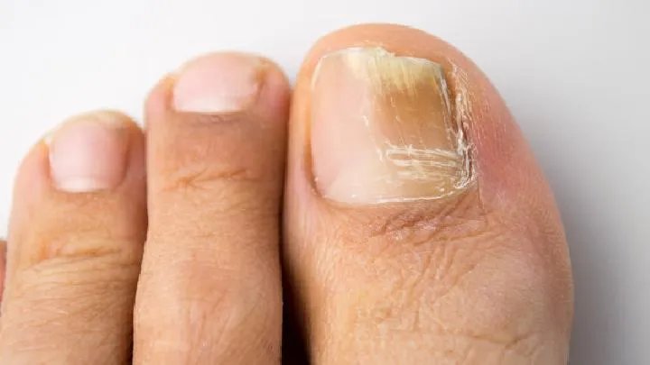 灰指甲的症状您知道多少?