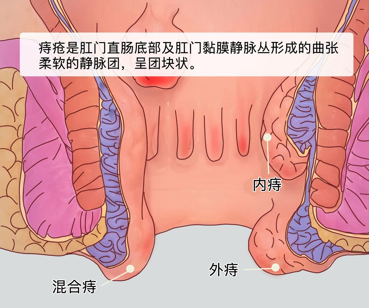 痔疮长什么样