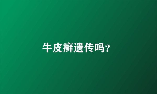 牛皮癣遗传吗？