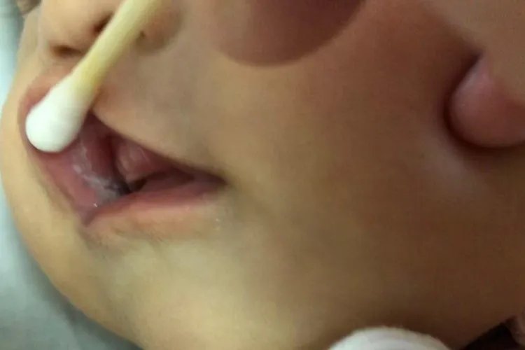 鹅口疮最初的症状图片