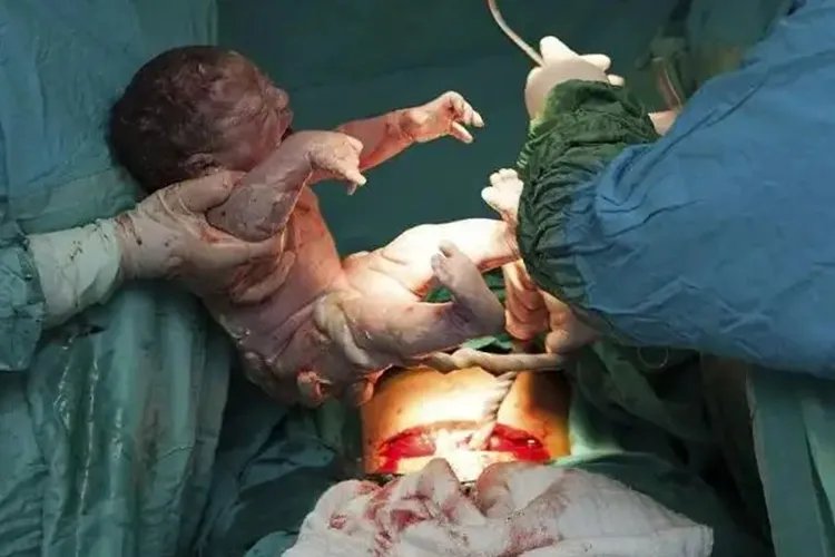 剖腹产图片