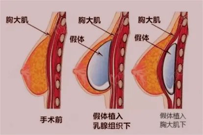 假体隆胸图片