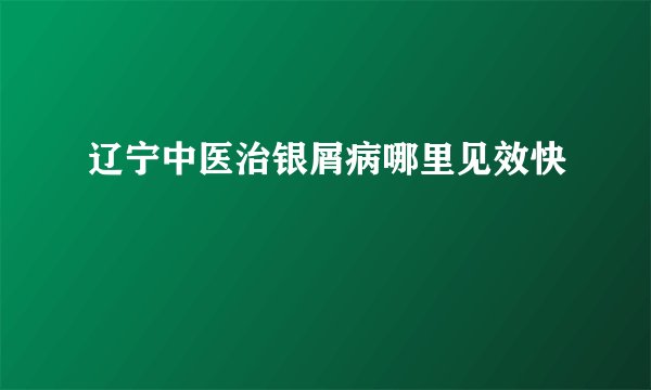 辽宁中医治银屑病哪里见效快
