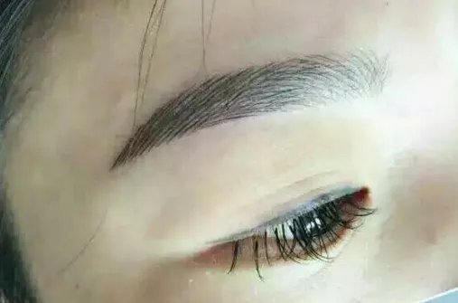 切眉手术价钱