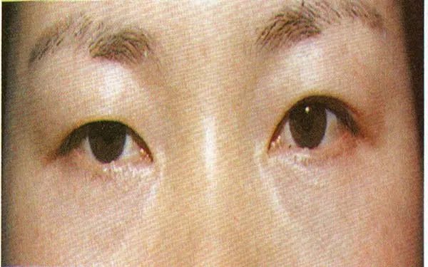 北京做双眼皮好的医院在哪里?