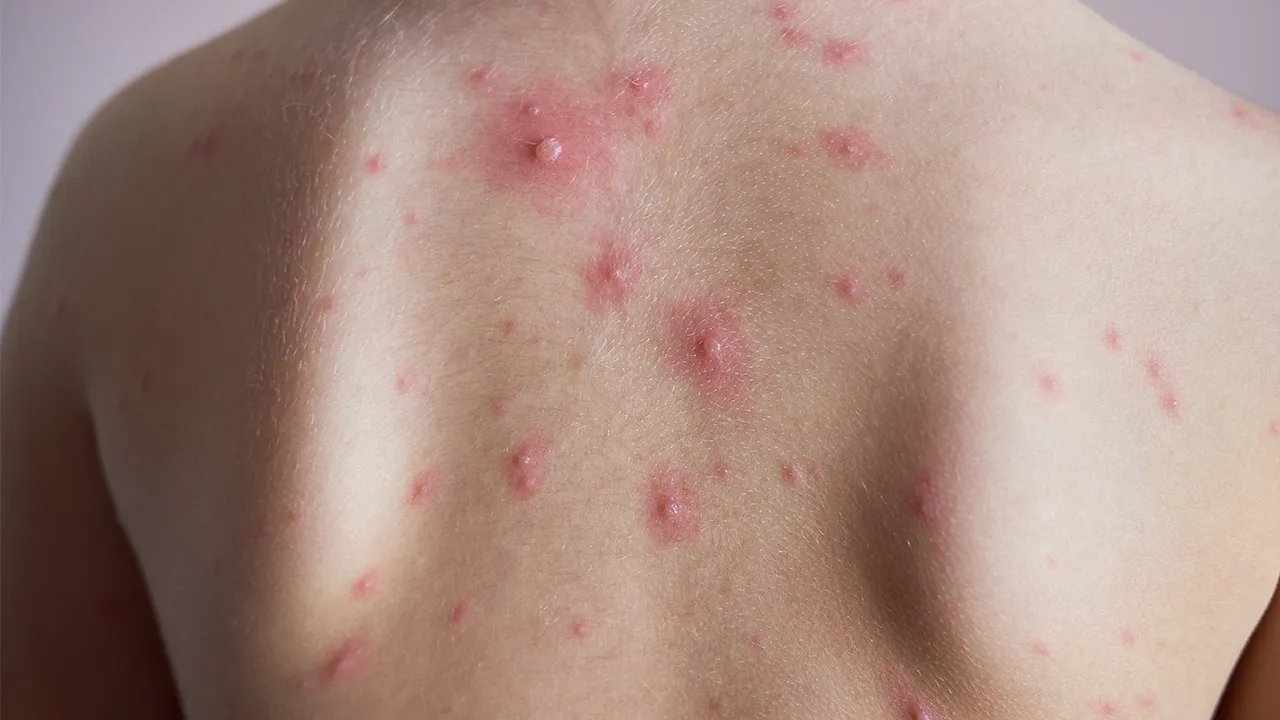 后背长痘痘是什么原因