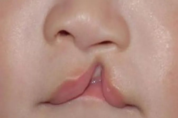 儿童兔唇图片