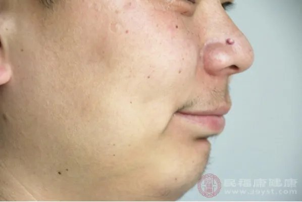 粉瘤是什么