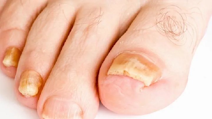 灰指甲中医治疗方法有哪些