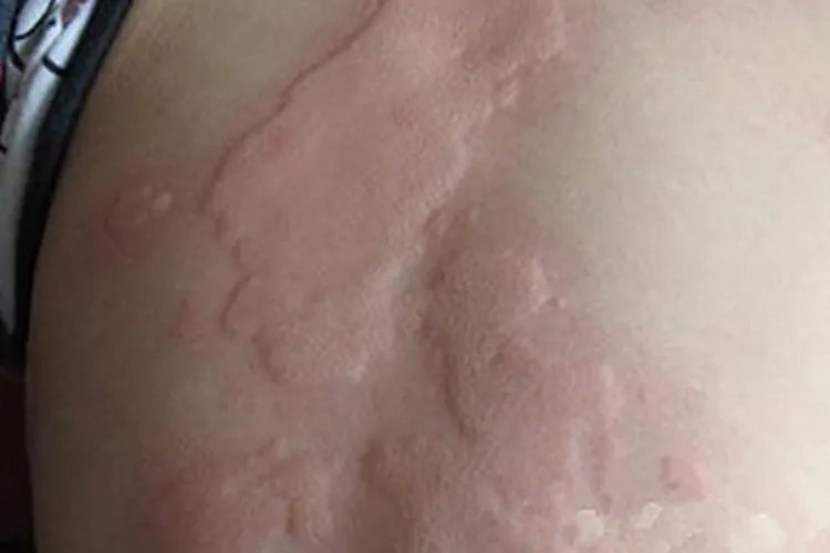 片状皮疹图片
