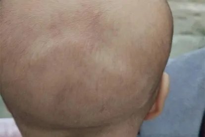 婴儿后脑勺有一圈弧形图片