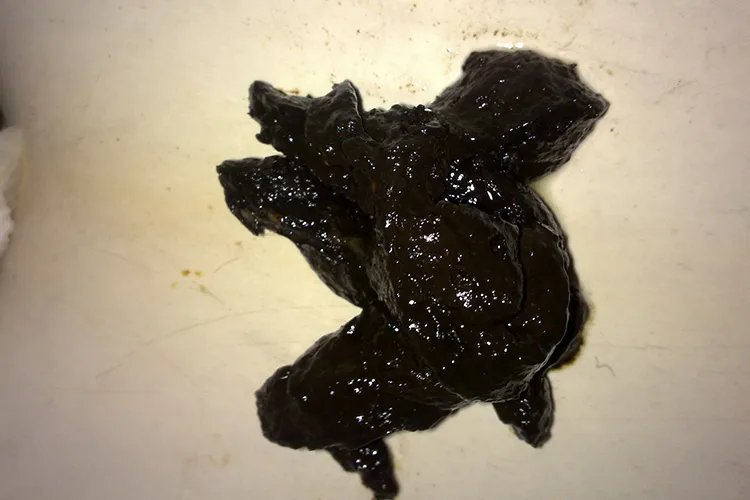 肠癌大便图片