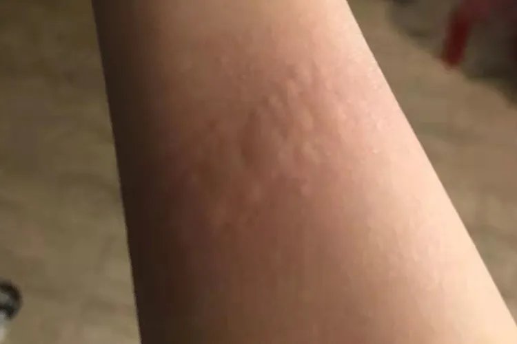 麻疹荨麻疹图片