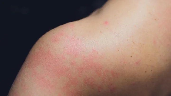 治疗神经性皮炎的偏方