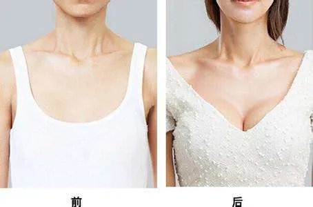 硅胶乳房再造适应的人群特征有哪些呢？