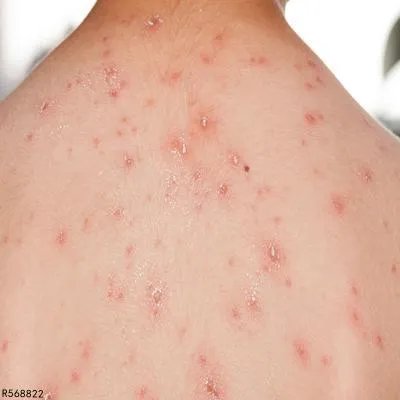 维a酸乳膏治扁平疣效果好不好 扁平疣有什么症状