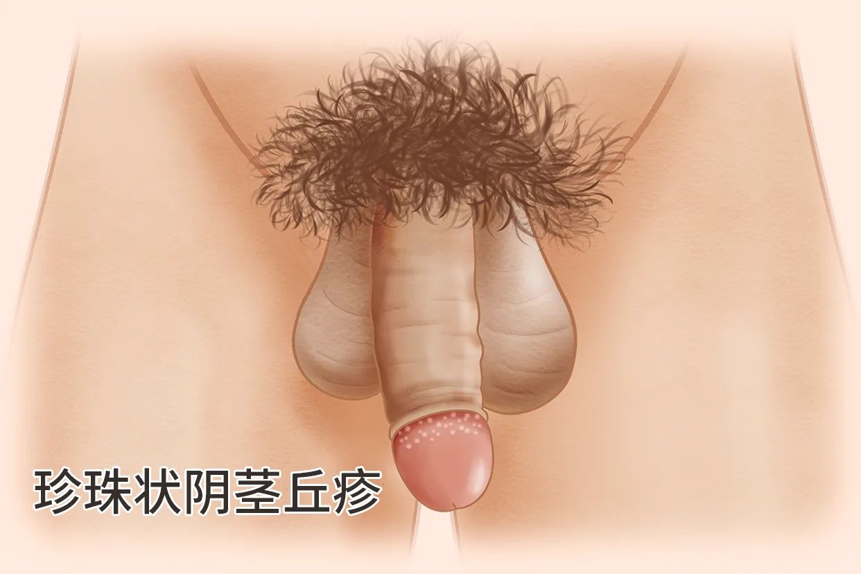 珍珠疹图片