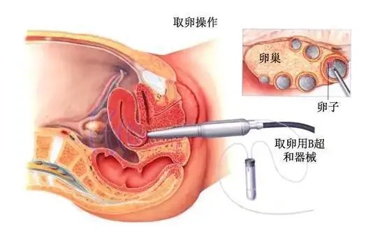 杭州供卵捐卵试管男宝-在杭州生男孩要多少钱?