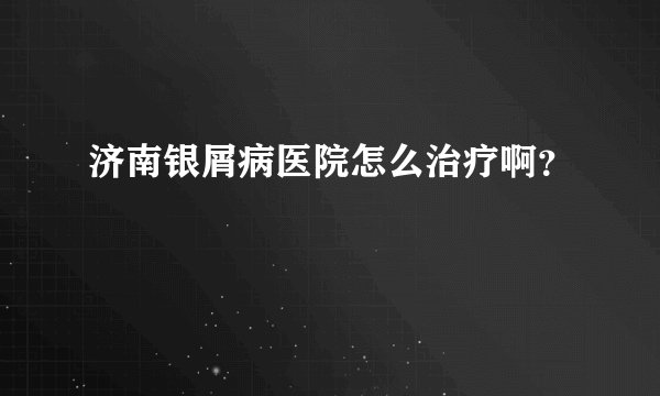 济南银屑病医院怎么治疗啊?