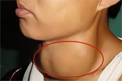 甲状腺下巴下面肿大图片