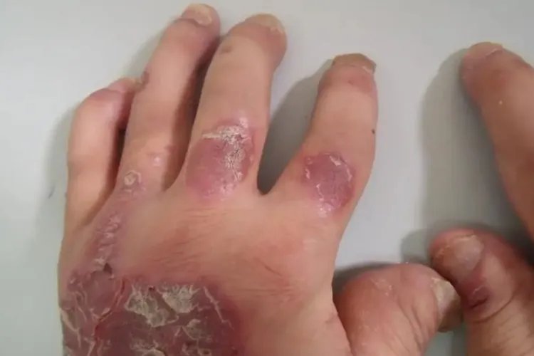 牛皮癣的几种症状图片