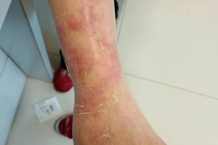 片状皮疹图片