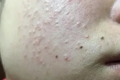 闭口丘疹图片