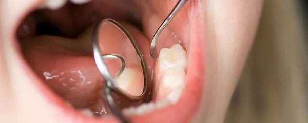 牙结石怎么去除小窍门