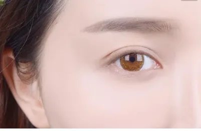 定位双眼皮有什么坏处