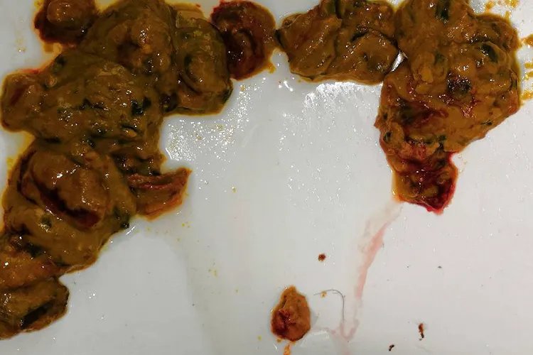 肠癌大便图片