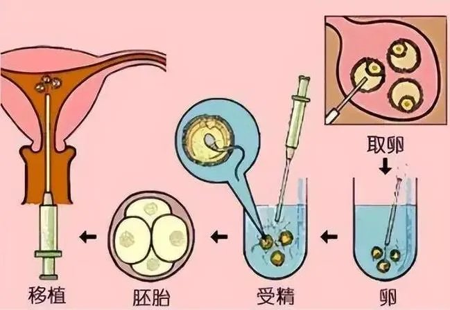 取卵过程