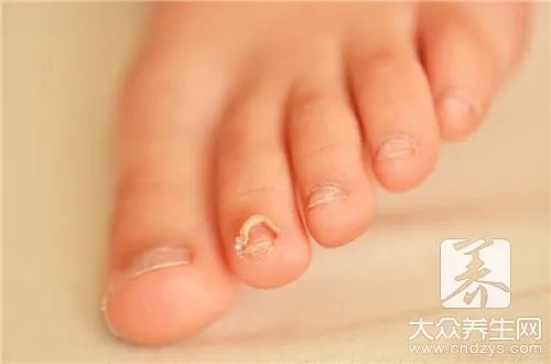 孩子脚指甲凹陷
