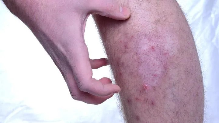 盘状红斑狼疮有什么典型的症状?
