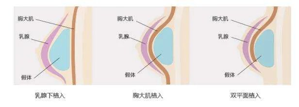 硅胶乳房再造适应的人群特征有哪些呢?