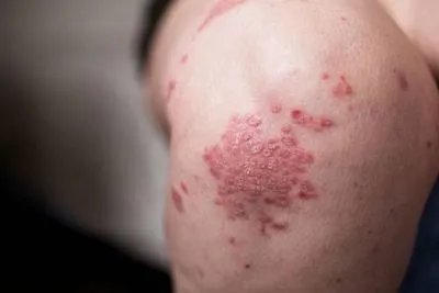 丘疹性湿疹用什么药膏