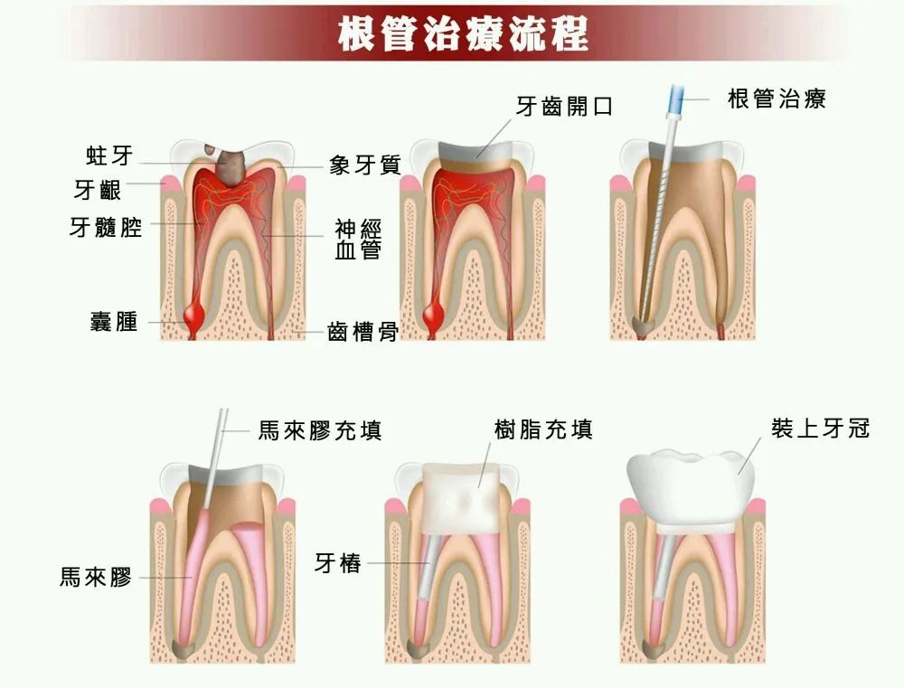 根管治疗