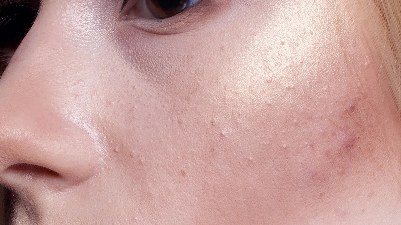 痤疮的中医治疗
