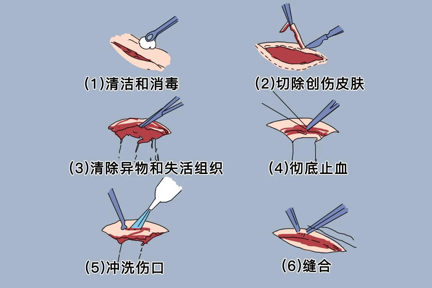 清创图片