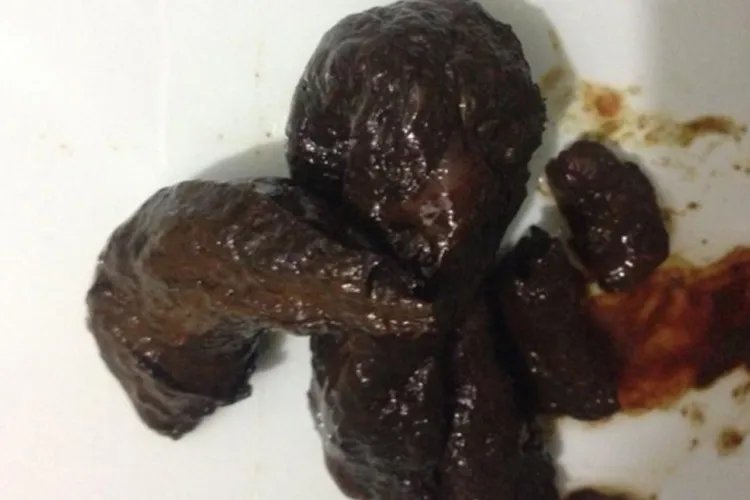 肠癌大便图片