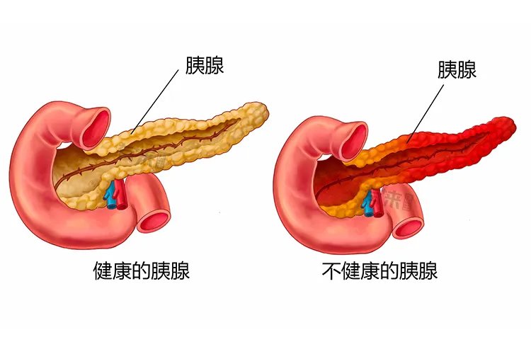 胰腺位置图