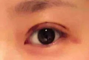 杭州一般做双眼皮多少钱